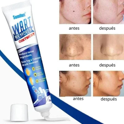 Wartsprotec® Tratamiento para pecas, manchas y Verrugas